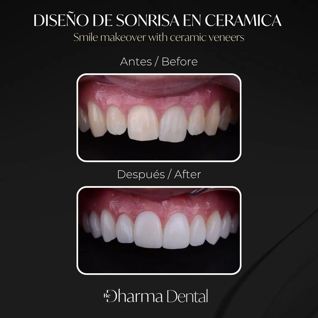 Diseño de sonrisa en cerámica antes y después en la clínica odontológica Be Dharma Dental - Medellín, Colombia- 040826