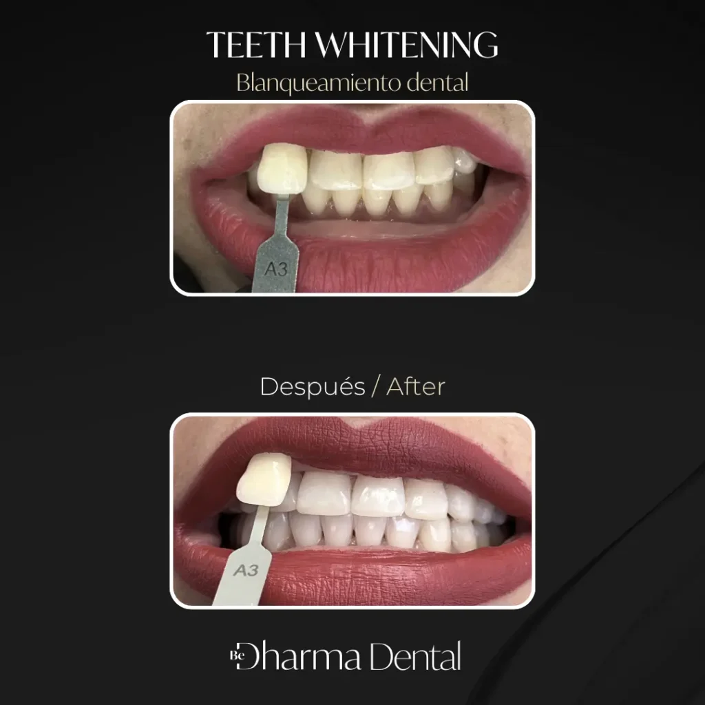 Teeth Whitening - Be Dharma Dental - Medellín, Colombia