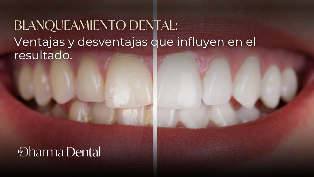 Blanqueamiento dental ventajas y desventajas que influyen en el resultado - Be Dharma Dental