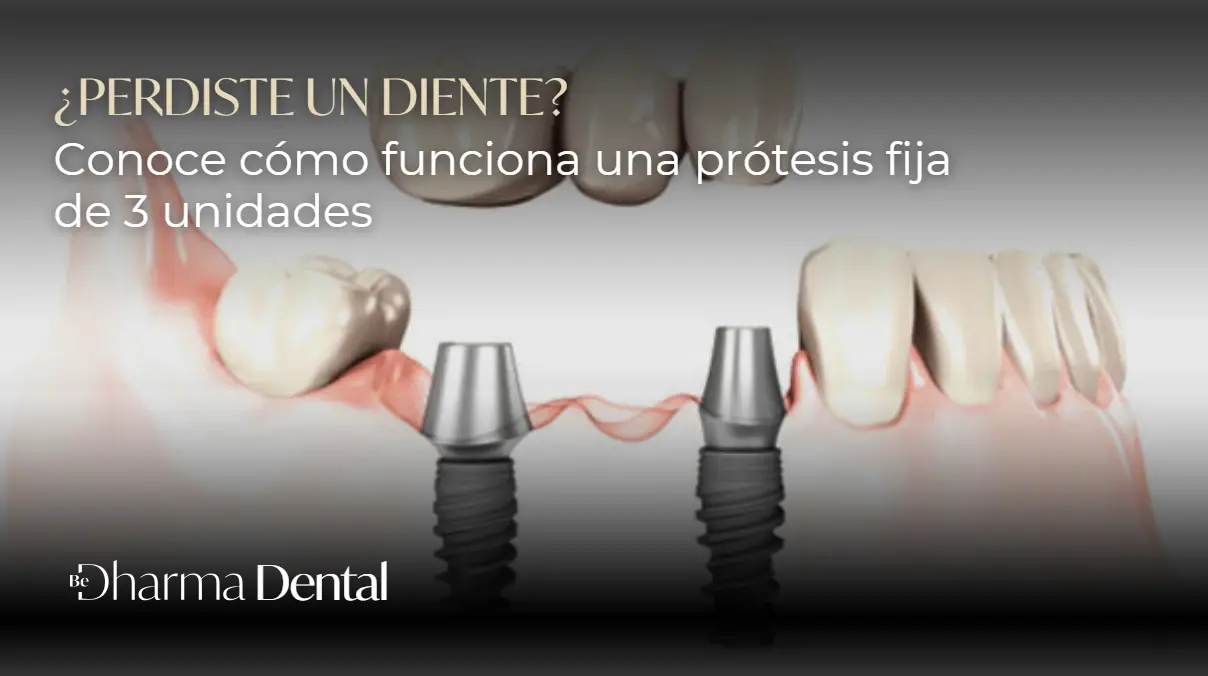 prótesis fija de 3 unidades- Be Dharma Dental Medellínn